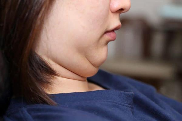 Causes of double chin